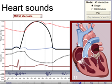 Heart sounds 2